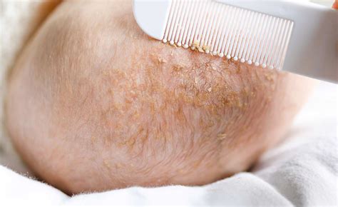 cradle cap in the elderly